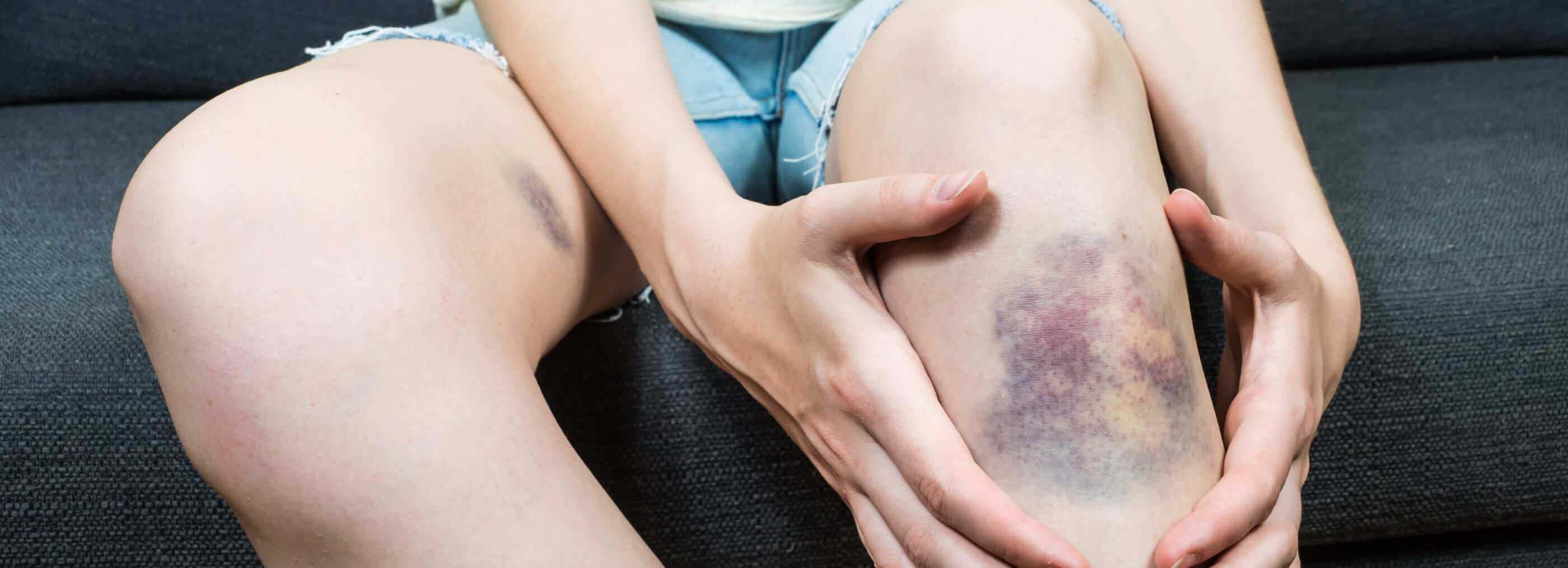 Terapia podciśnieniowa ran NPWT / VAC Warszawa i Płock | OpenMed